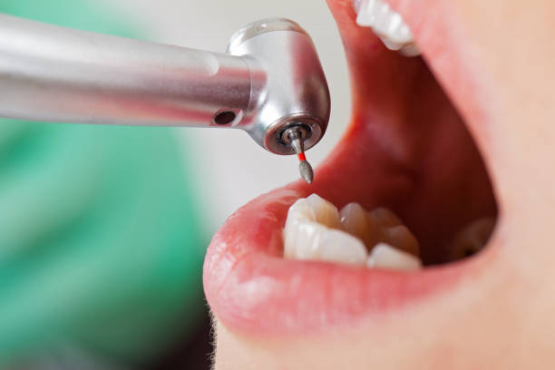 Best Emergency Tooth Extraction in Rosemont, CA